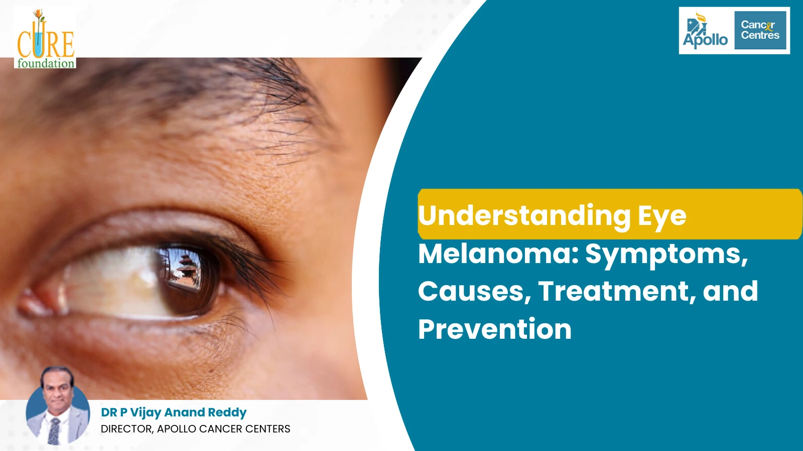 Understanding Eye Melanoma: Symptoms, Causes, Treatment, and Prevention