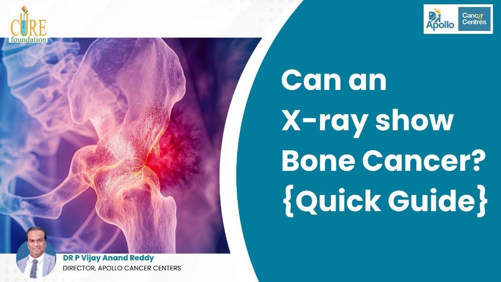 Can an X-ray show Bone Cancer? {Quick Guide}