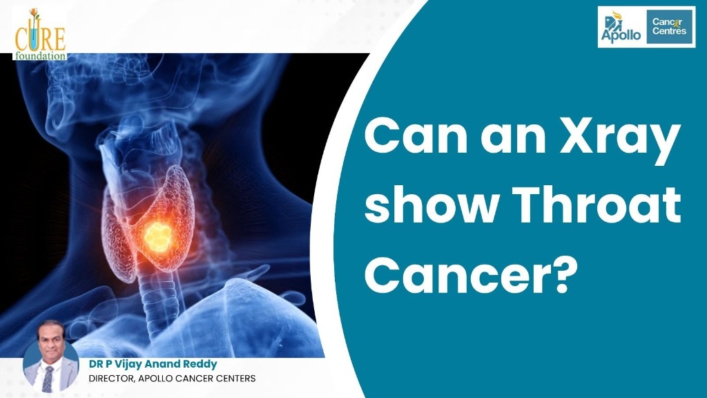 Can an Xray show Throat Cancer?