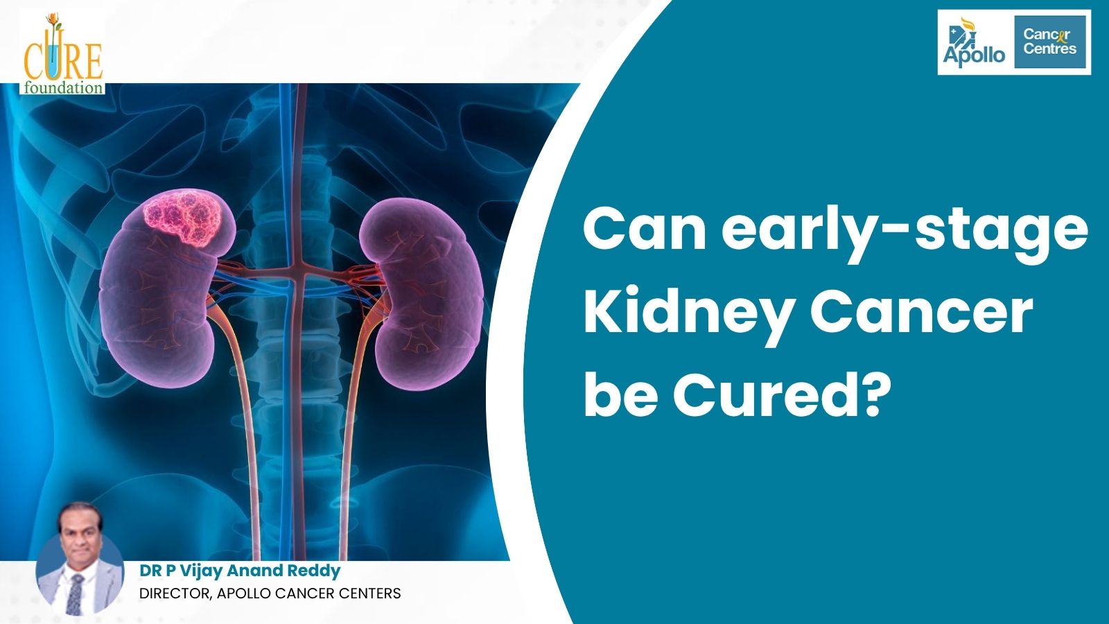 Can early-stage Kidney Cancer be Cured?