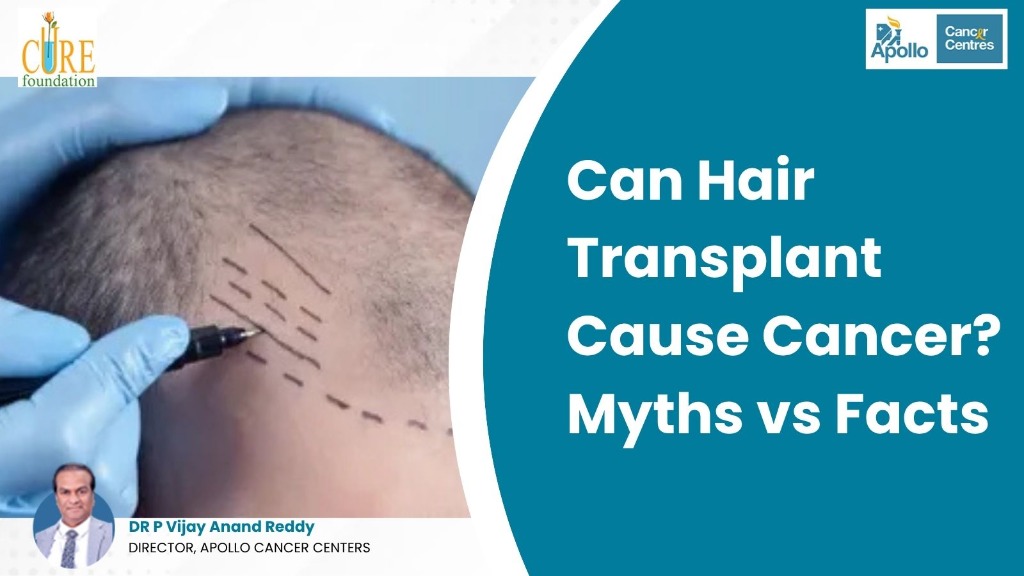 Can Hair Transplant Cause Cancer? {Myths vs Facts}