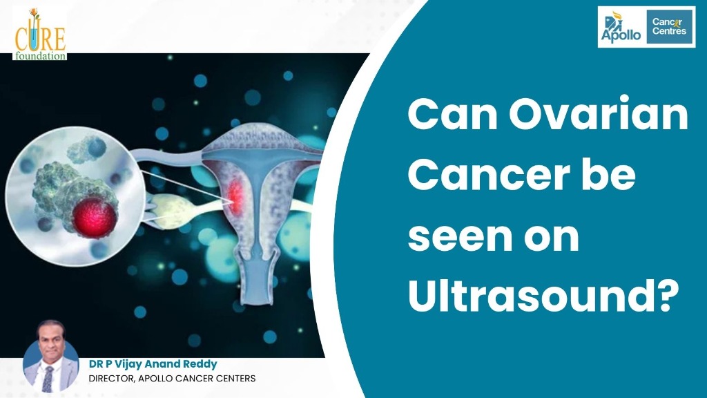 Can Ovarian Cancer be seen on Ultrasound?