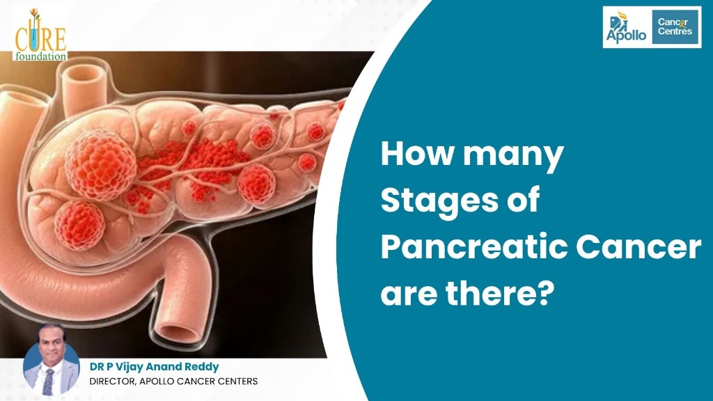 How many Stages of Pancreatic Cancer are there?