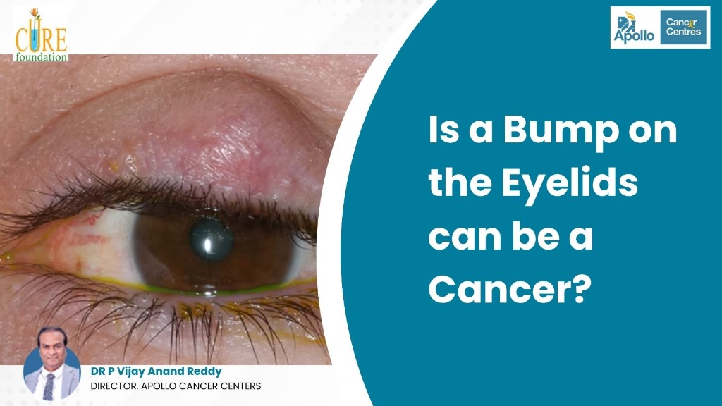 Is a Bump on the Eyelids Can Be a Cancer? Causes, Symptoms & Treatment