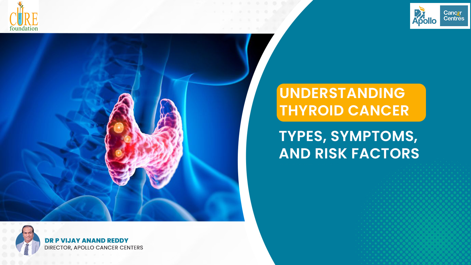 Understanding Thyroid Cancer: Types, Symptoms, and Risk Factors