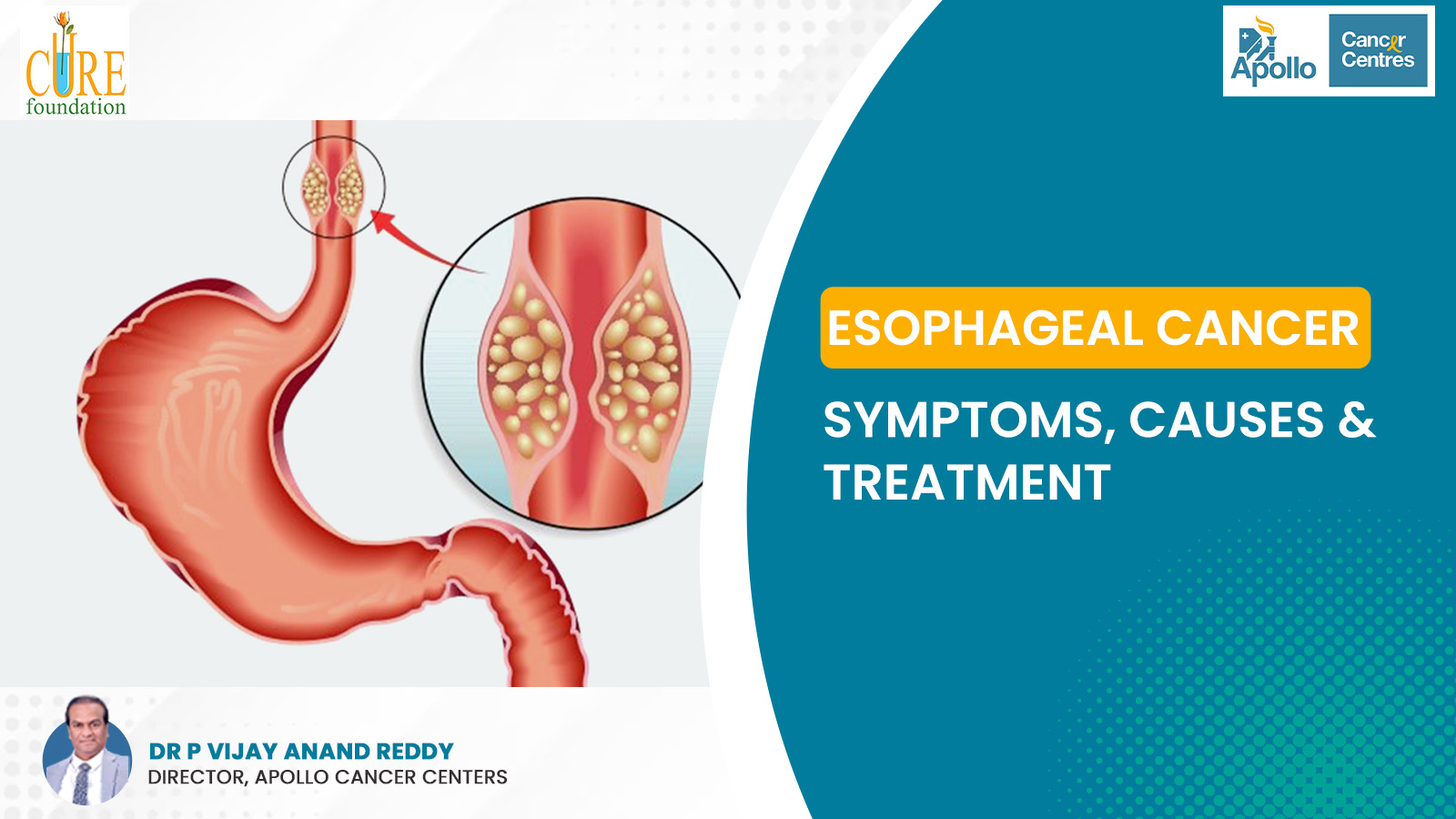 Esophageal Cancer: Symptoms, Causes & Treatment