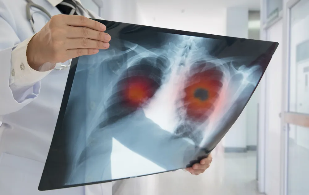 Lung Cancer Treatment Cost in India