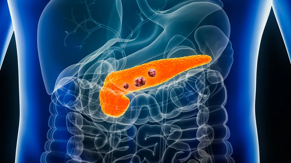 Pancreatic Cancer Treatment in India