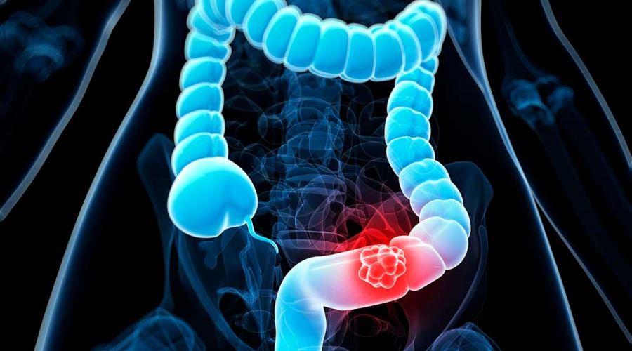 Rectum Cancer