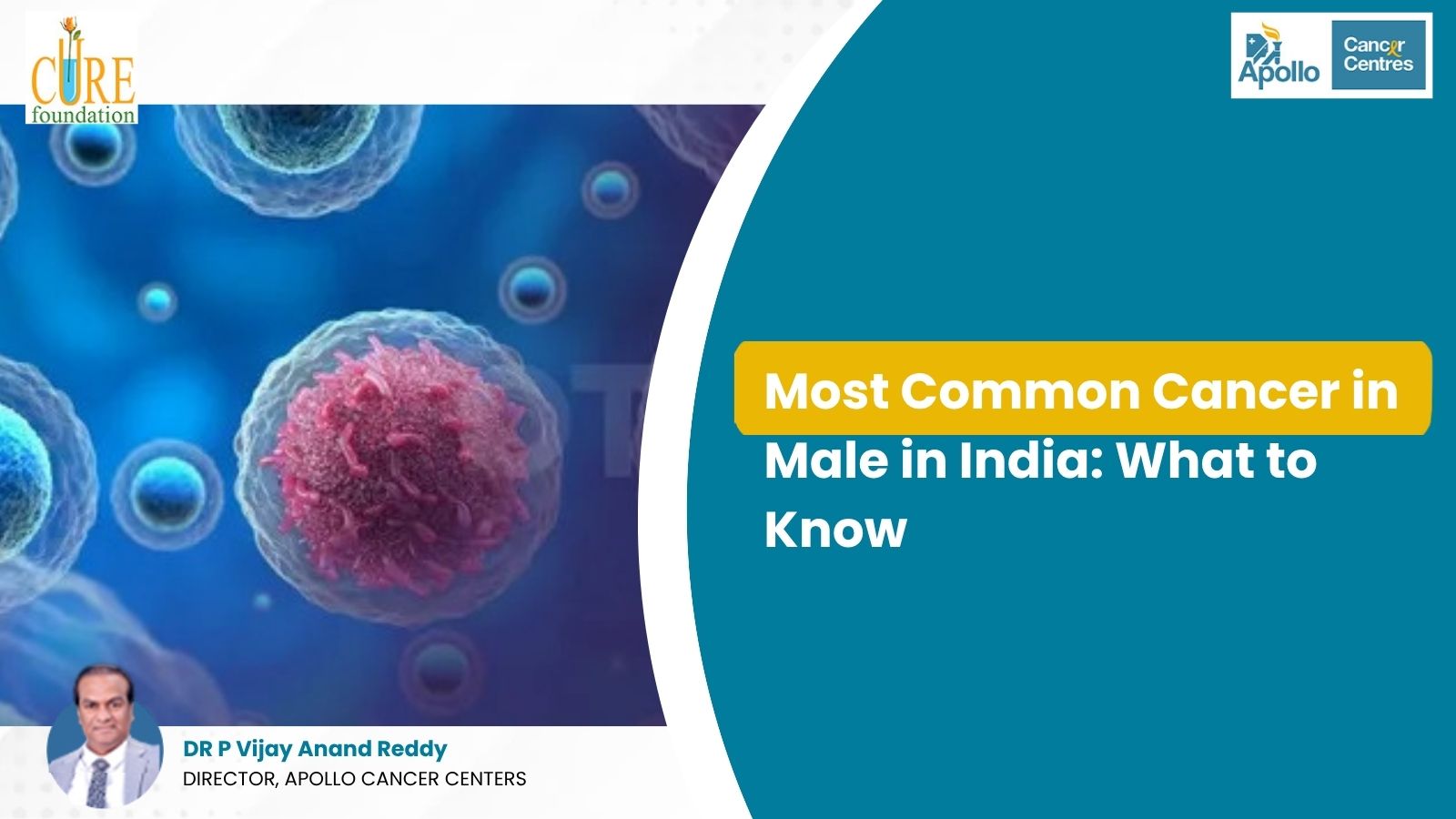 Most Common Cancer in Male in India