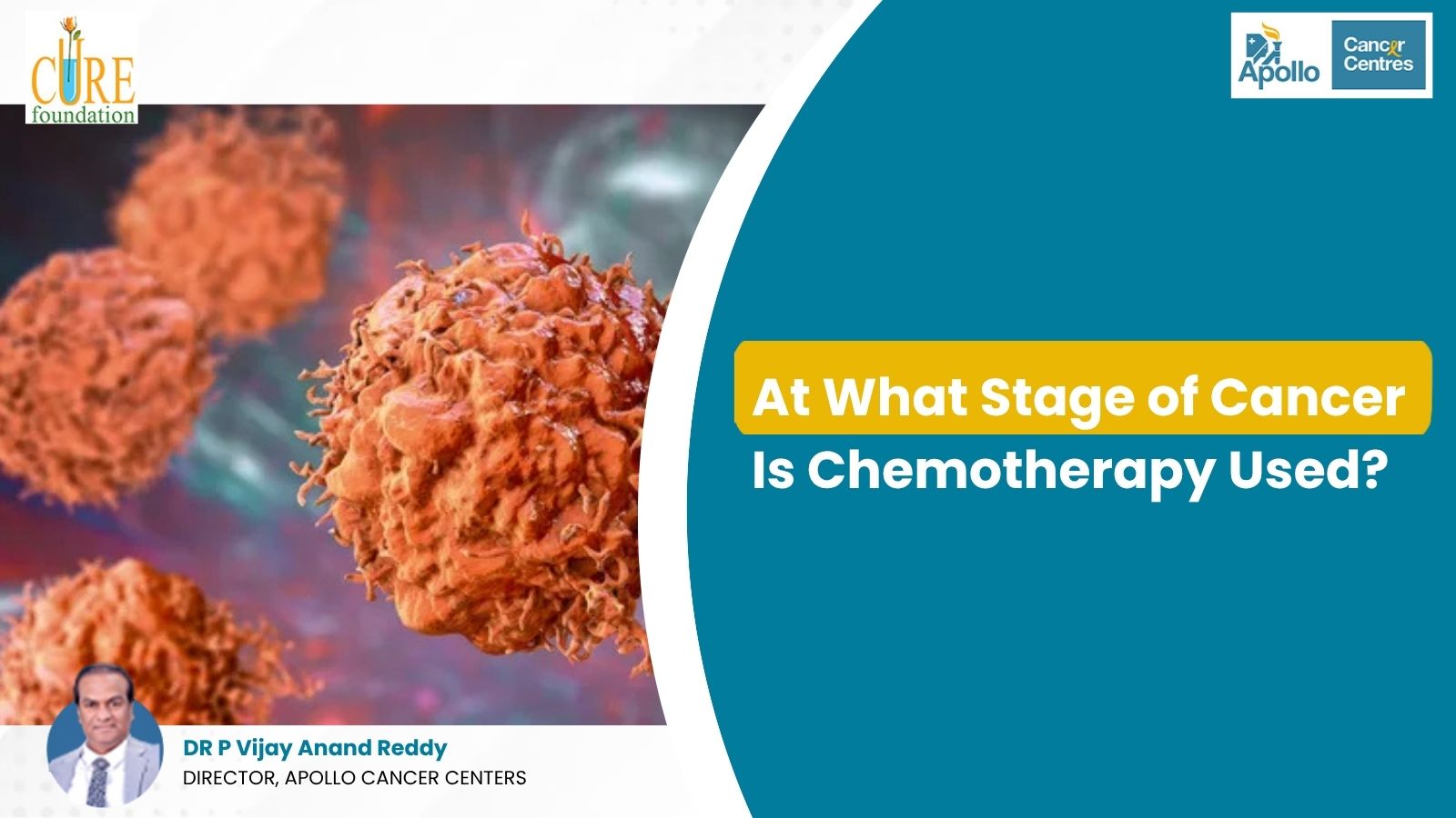 At What Stage of Cancer Is Chemotherapy Used?