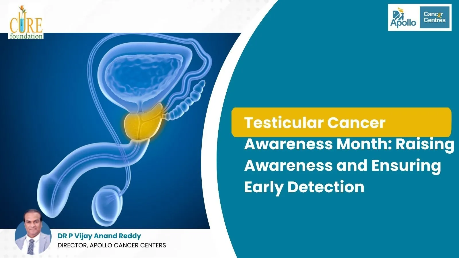Testicular Cancer
