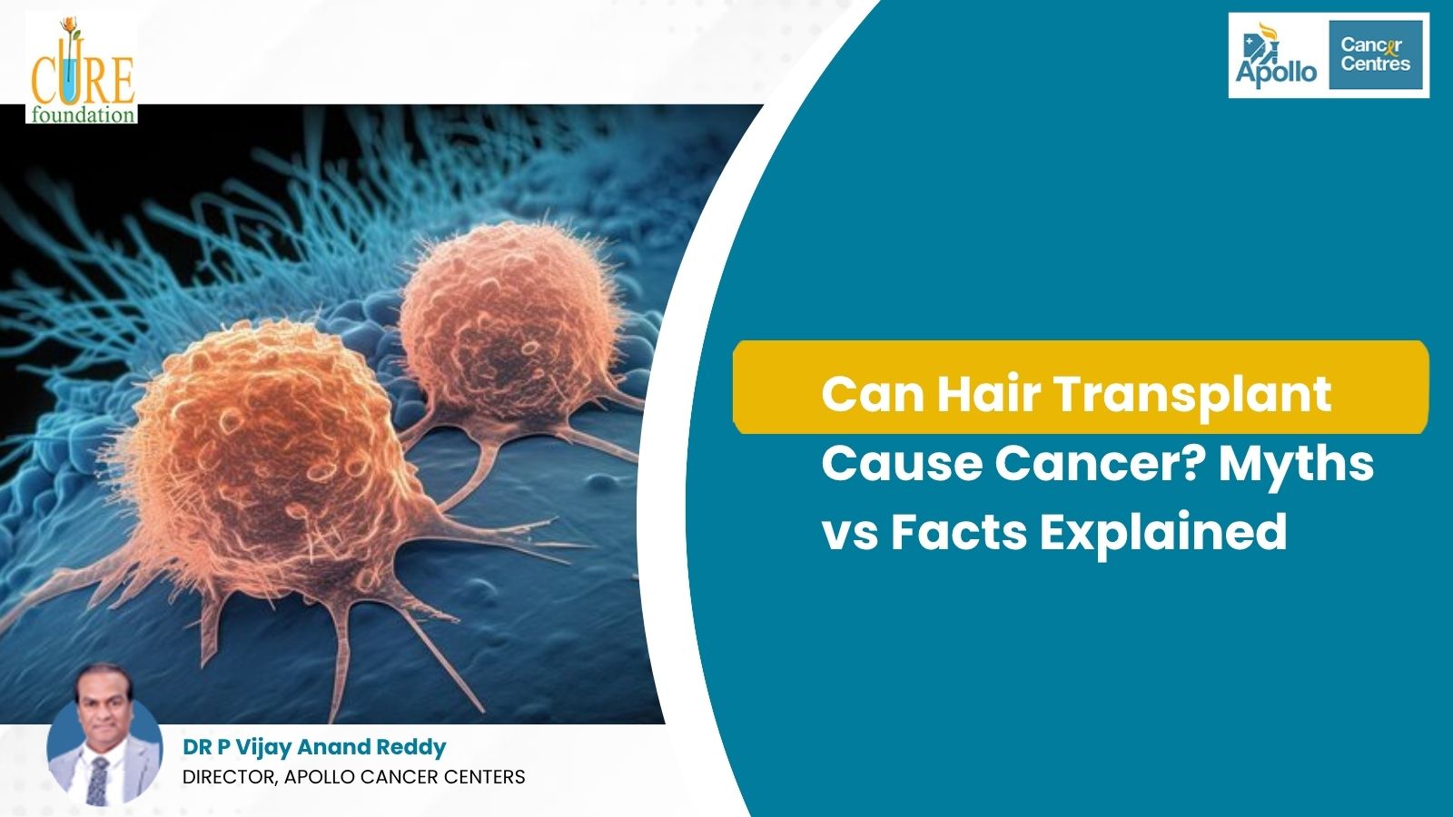 Can Hair Transplant Cause Cancer
