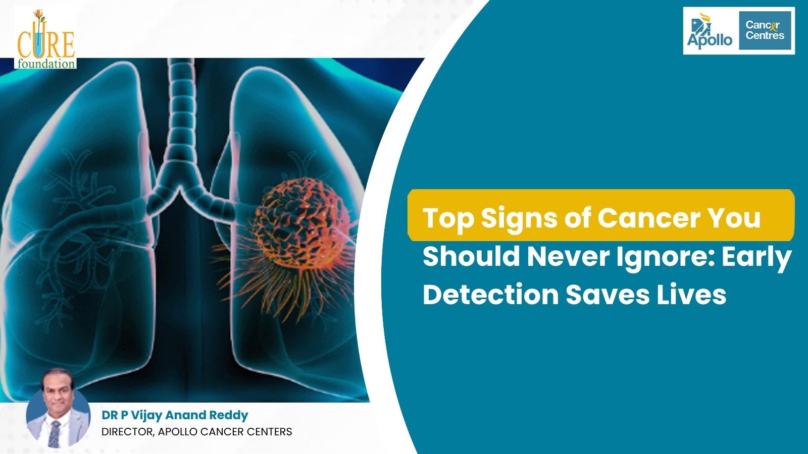 Top Signs of Cancer You Should Never Ignore