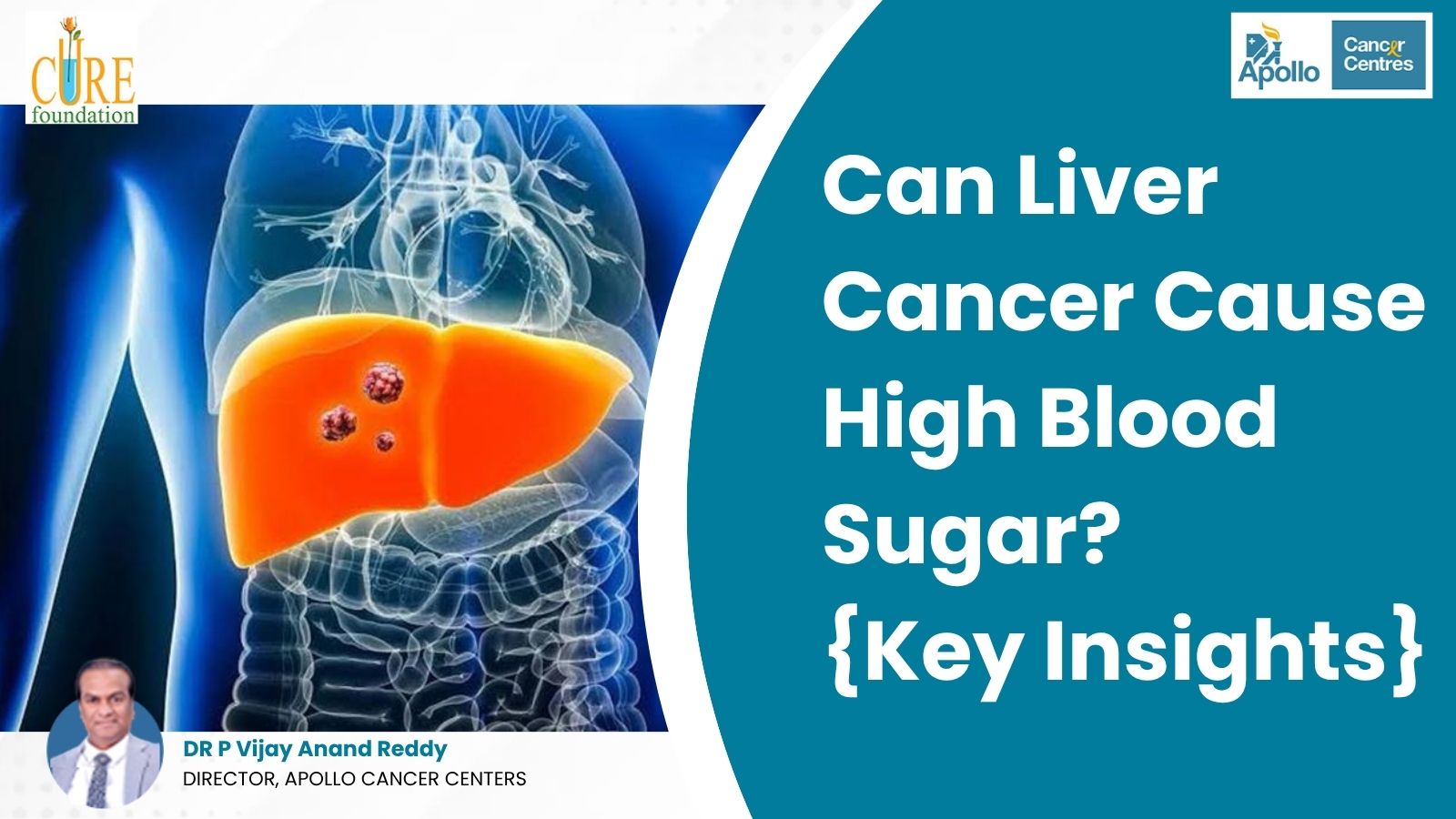 Can Liver Cancer Cause High Blood Sugar