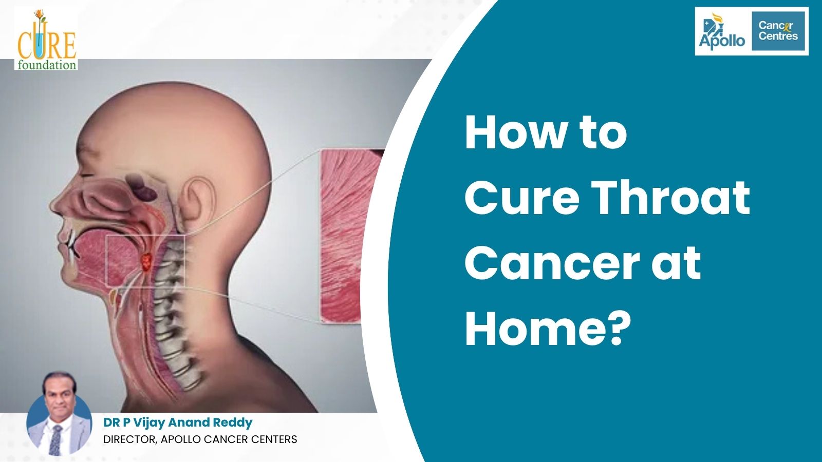 How to Cure Throat Cancer at Home